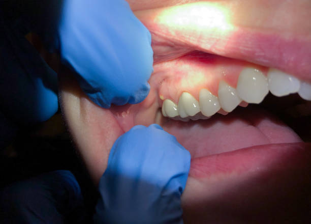 Best Emergency Wisdom Teeth Removal in Hightstown, NJ