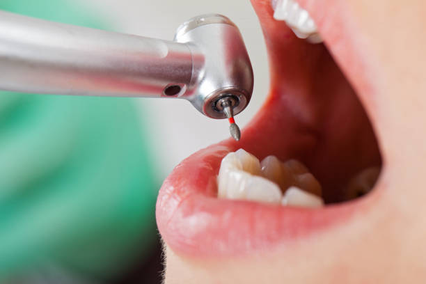 Best Emergency Root Canal Treatment in Hightstown, NJ